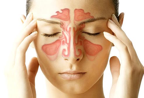 sinusitis