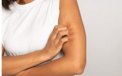 Contact Dermatitis